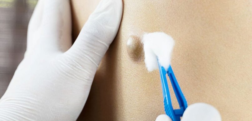 Torbiel włosowa – przebieg zmian i możliwości leczenia