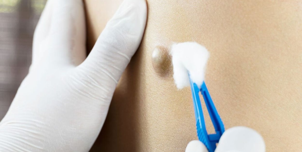 Torbiel włosowa – przebieg zmian i możliwości leczenia